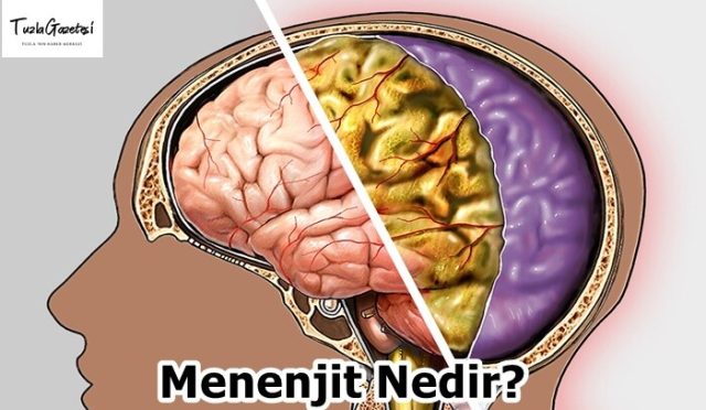 Menenjit Nedir