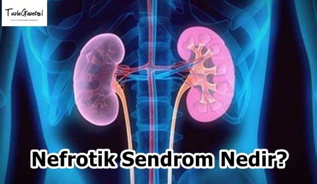 Nefrotik Sendrom Nedir