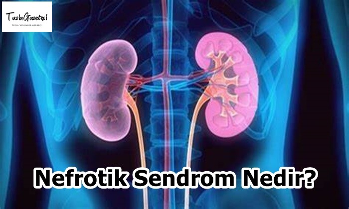 Nefrotik Sendrom Nedir?