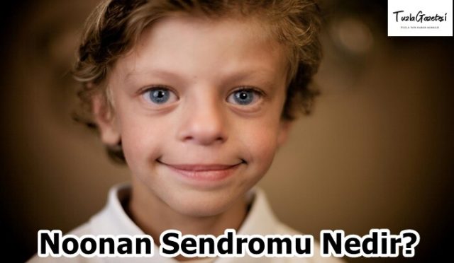 Noonan Sendromu Nedir