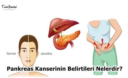 Pankreas Kanserinin Belirtileri Nelerdir