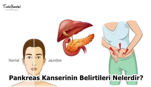 Pankreas Kanserinin Belirtileri Nelerdir