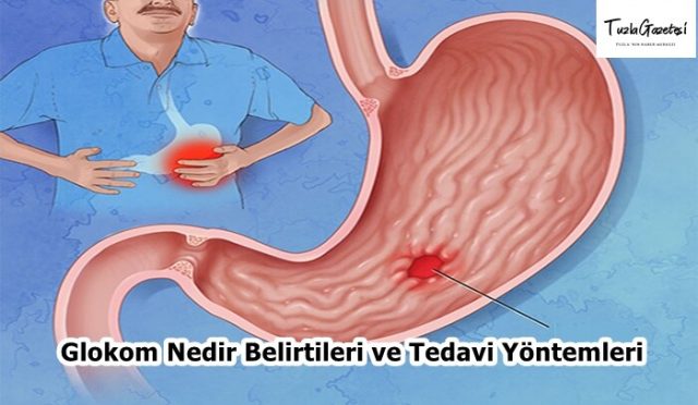 Peptik Ülser Nedir Belirtileri ve Tedavi Yöntemleri