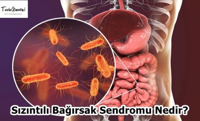 Sızıntılı Bağırsak Sendromu Nedir
