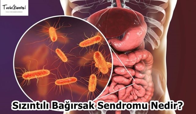 Sızıntılı Bağırsak Sendromu Nedir