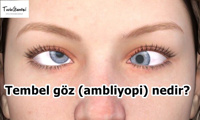 Tembel göz (ambliyopi) nedir?