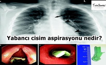 Yabancı cisim aspirasyonu nedir