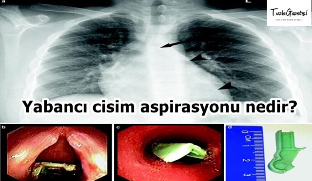 Yabancı cisim aspirasyonu nedir