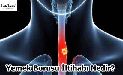 Yemek Borusu İltihabı Nedir
