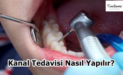 Kanal Tedavisi Nasıl Yapılır
