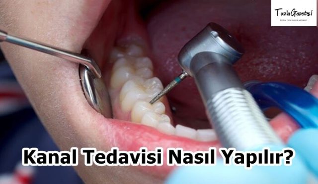 Kanal Tedavisi Nasıl Yapılır