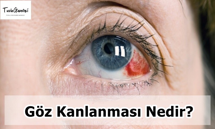 Göz Kanlanması Nedir