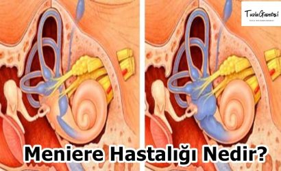 Meniere Hastalığı Nedir