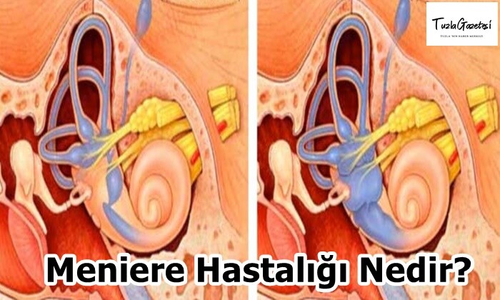 Meniere Hastalığı Nedir?