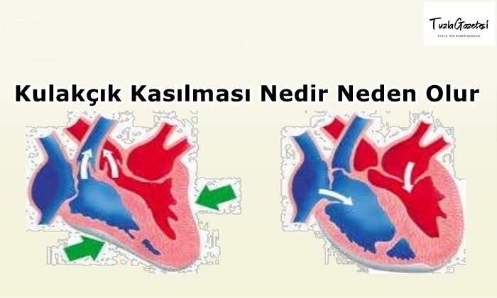 Kulakçık Kasılması Nedir Neden Olur