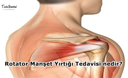 Rotator Manşet Yırtığı Tedavisi