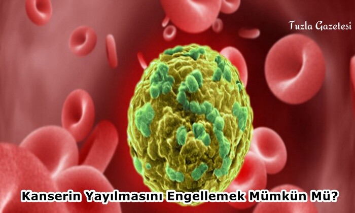 Kanserin Yayılmasını Engellemek Mümkün Mü?