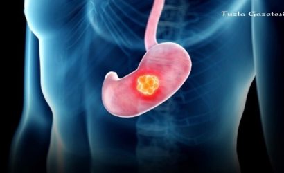 Mide Kanseri Nedir, Nasıl Tedavi Edilir